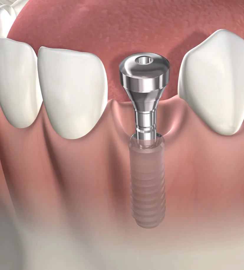 query  tooth replacement options