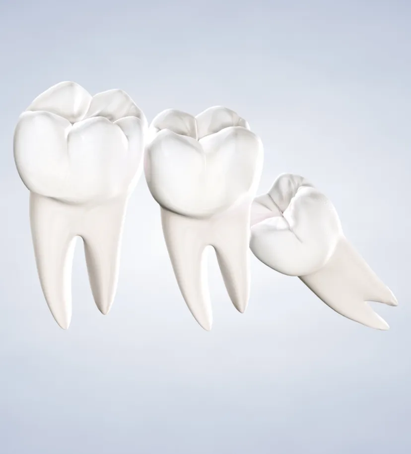 query  wisdom teeth removal